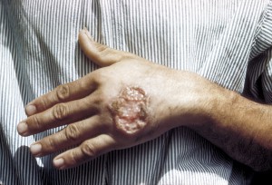 1024px-Skin_ulcer_due_to_leishmaniasis,_hand_of_Central_American_adult_3MG0037_lores