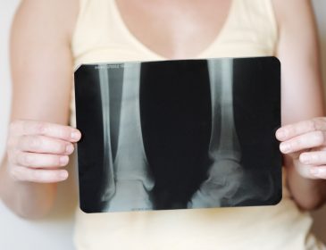 Osteoporoza, czyli ogłupiania lekarzy ciąg dalszy